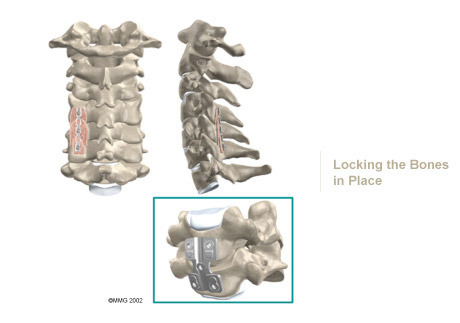 Neck 24