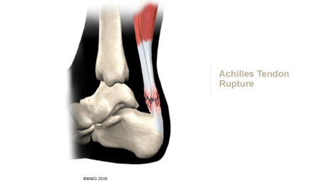 Ankle Physiomed