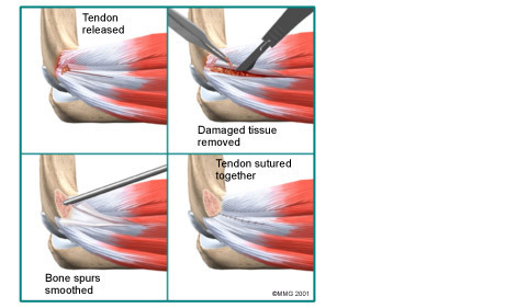 Elbow - Physiomed